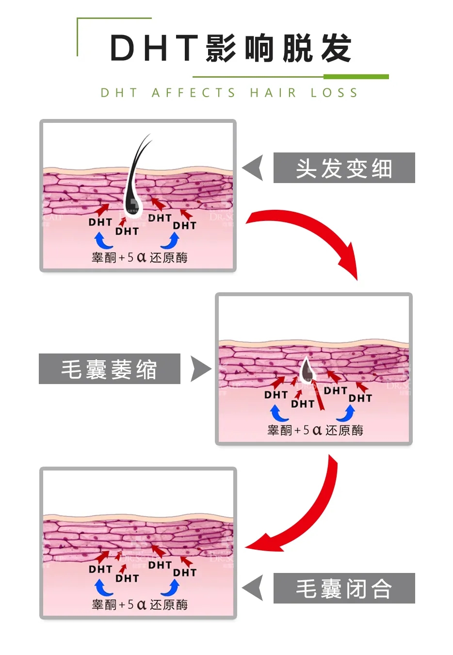 男性脱发